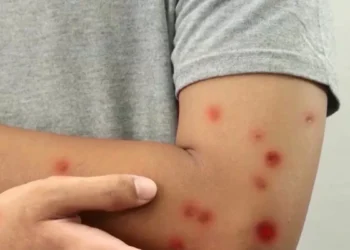 Detectan segundo caso de sarampión en Montevideo y monitorean su circunstancia, informó el MSP